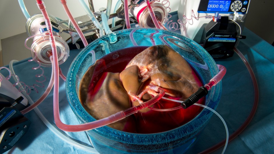 photo of a human liver during machine perfusion while it is being preconditioned with protective agents for supercooled storage