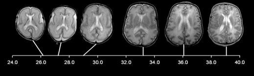 MRI scans of a developing fetus brain