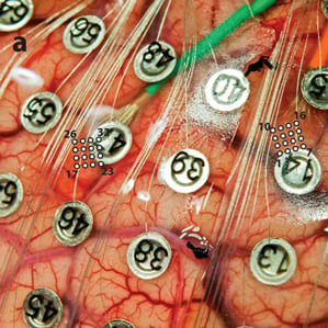 a sheet of electrodes on the surface of the brain