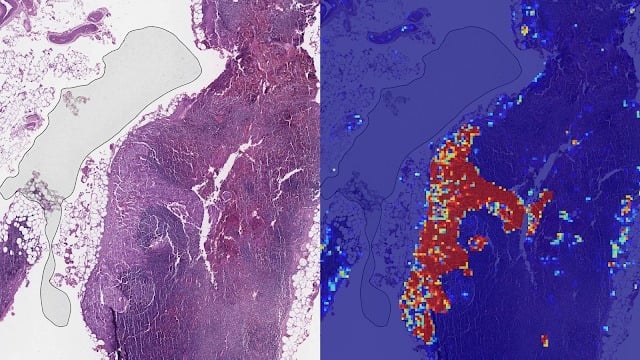View of two clinical slides side-by-side with the AI tumor diagnosis on the right