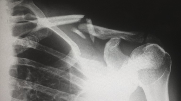X-ray of an upper arm