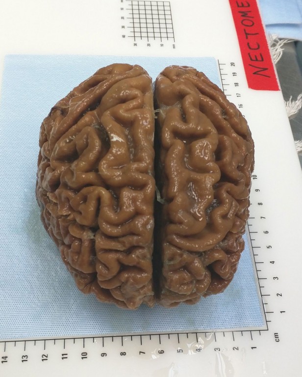The brain of an elderly woman, preserved using fixative chemicals