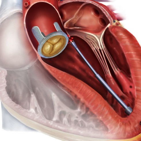 An artists rendering of the robotic catheter inserted into a heart