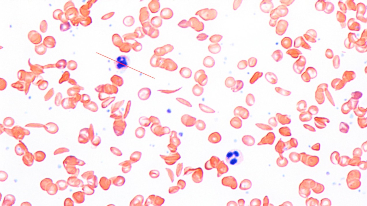 Micrograph of sickle cells