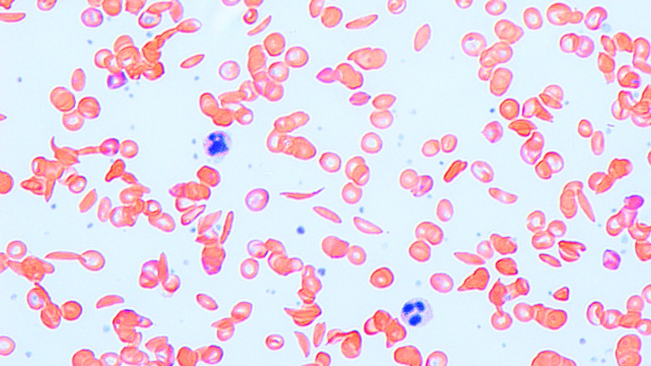 Эритроциты при серповидно клеточной анемии. Микроскопе серповидноклеточная анемия. Серповидноклеточная анемия мазок крови. Серповидноклеточная анемия мазок. Эритроциты на белом фоне.